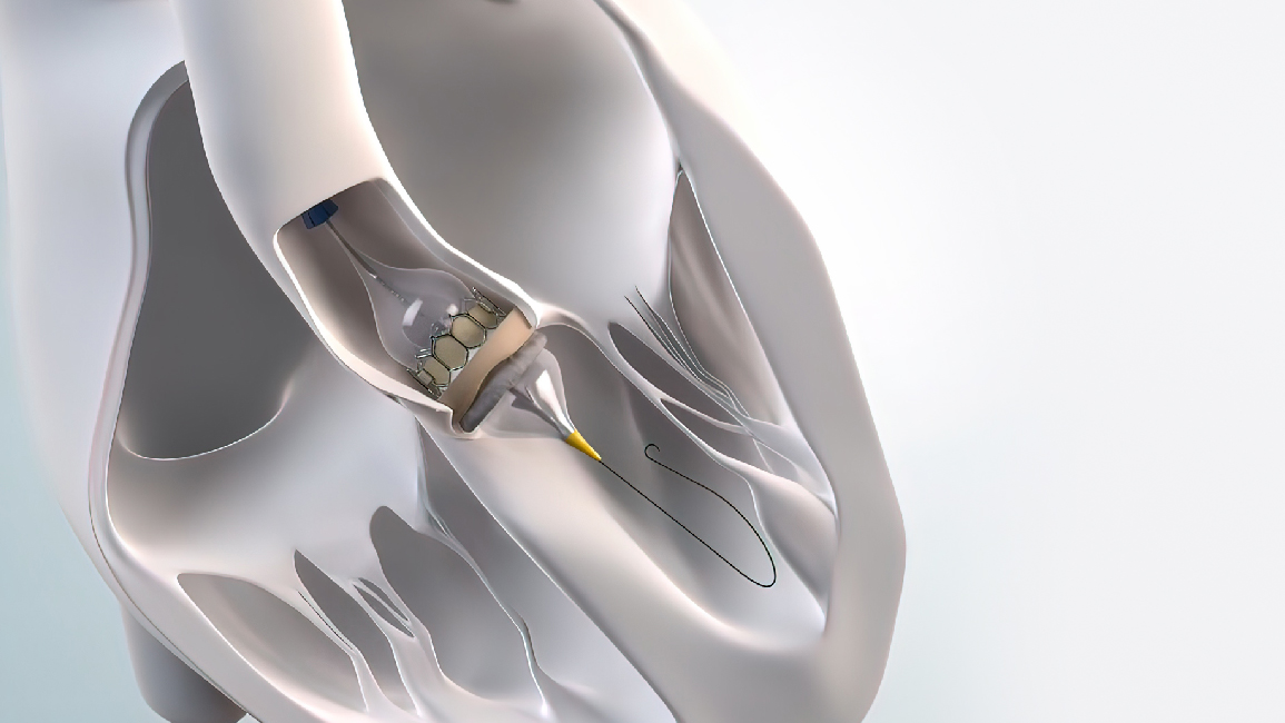 Transcatheter valve replacement (TAVI) and biplane techniques reduce pain without surgical scars